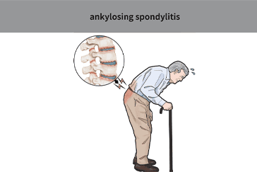 Ankylosing Spondylitis – Causes, Symptoms, Treatment at Home & More